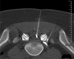 Ct Gesteuerte Nervenwurzelbehandlung Prt